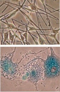 Melanocitos normales (arriba) en comparación con los senescentes melanocitos con mutaciones causantes de cáncer (en la parte inferior). Fotografía: María S. Soengas, Ph.D., Escuela de Medicina de UM