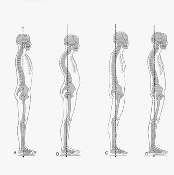 Figuras humanas con diferentes alianeamientos de columna vertebral.